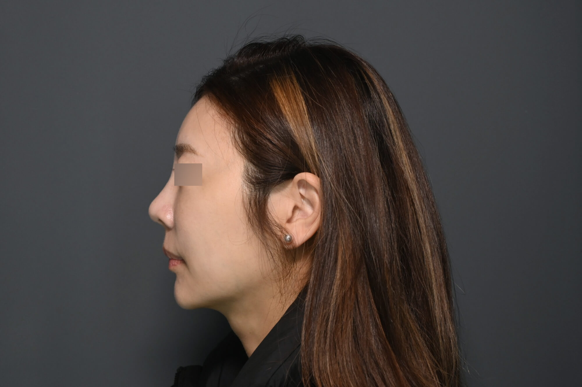 【海芙電音雙波】療程前After-小嫚